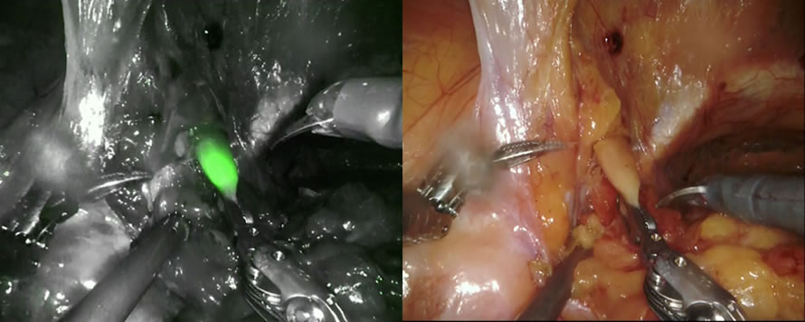 ロボットを用いた前立腺摘除 写真