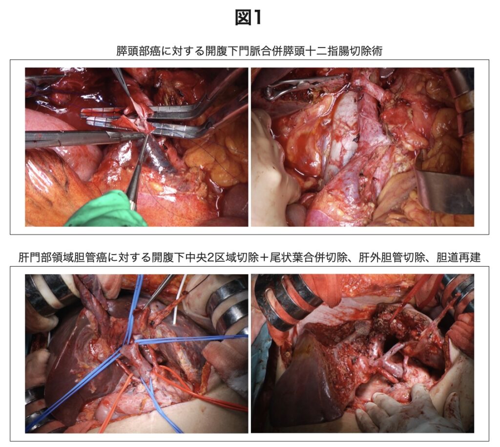 写真「膵頭部癌に対する開腹下門脈合併膵頭十二指腸切除術」「肝門部領域胆管癌に対する開腹下中央2区域切除+尾状葉合併切除、肝外胆管切除、胆道再建」