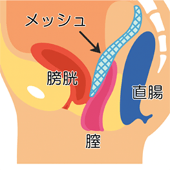Laparoscopic Sacrocolpopexy
メッシュ位置解説