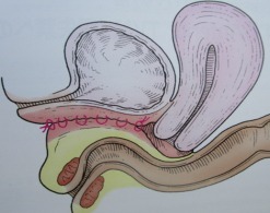 Native tissue repair 解説イラスト