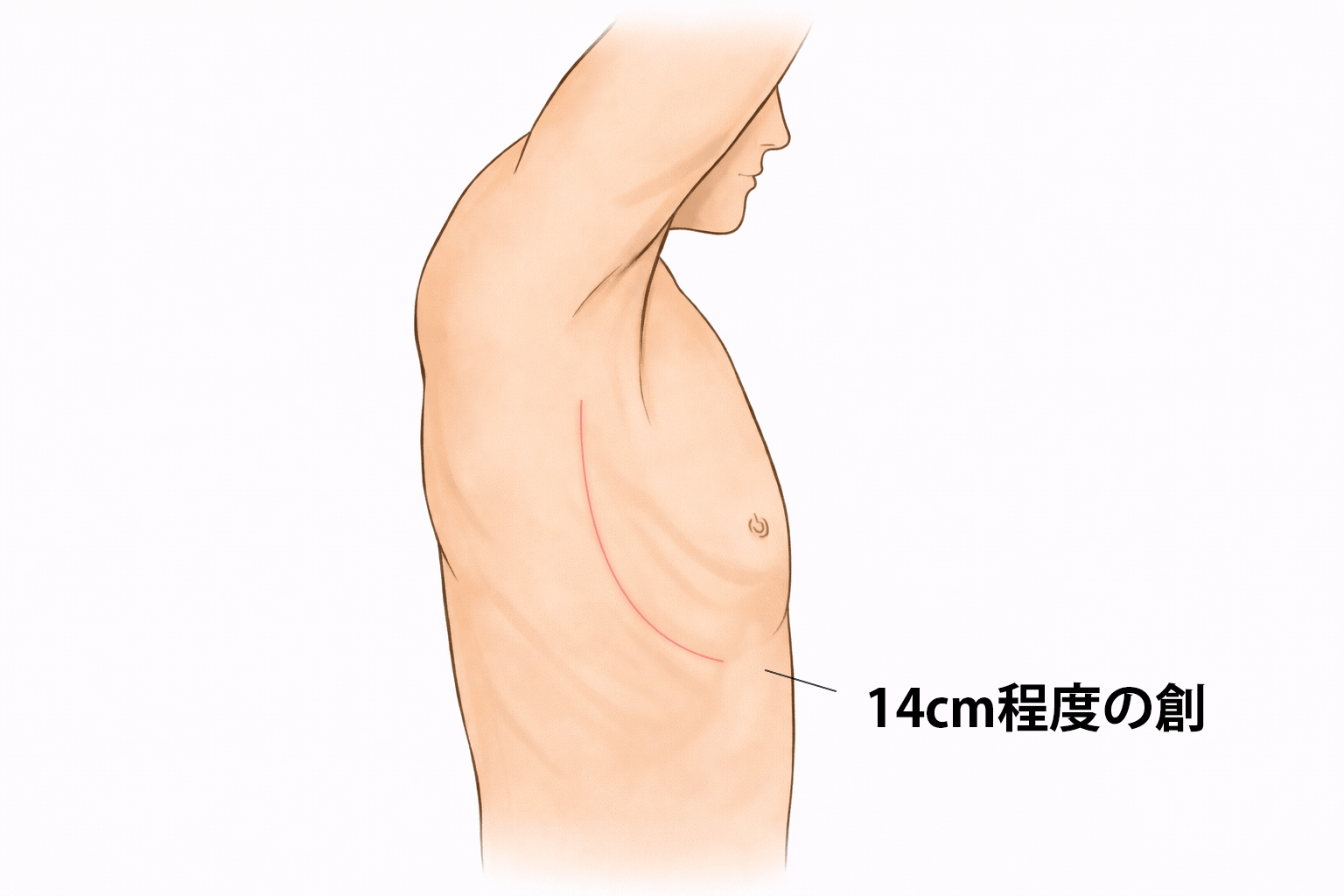開胸手術イラスト 14cm程度の創