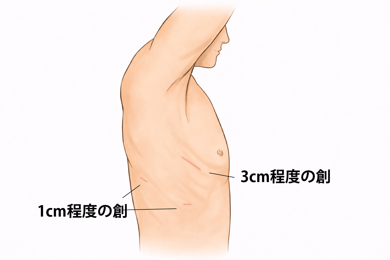 胸腔鏡下手術(従来式)イラスト
2箇所の1cm程度の創、1箇所の3cm程度のの創