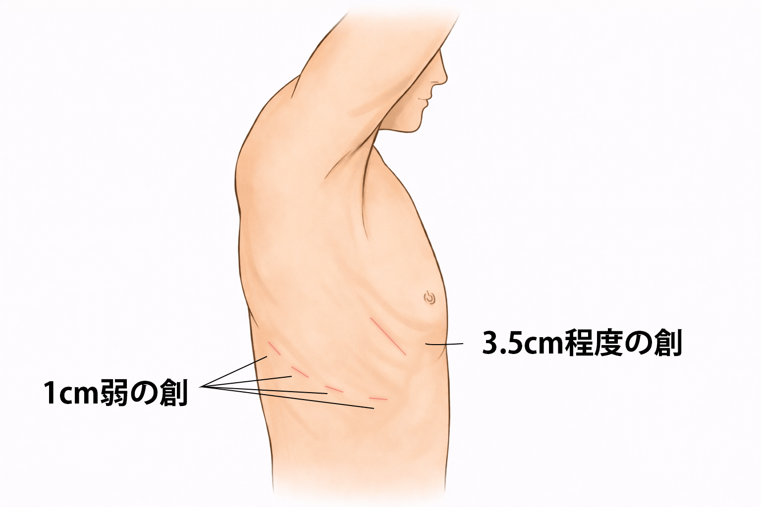 ロボット支援下手術(従来式)イラスト
4箇所に1cm弱の創、1箇所に3.5cm程度のの創