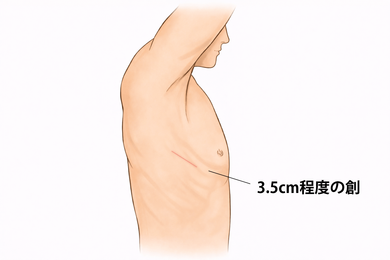 胸腔鏡下手術(単孔式)イラスト
1箇所の3.5cm程度のの創