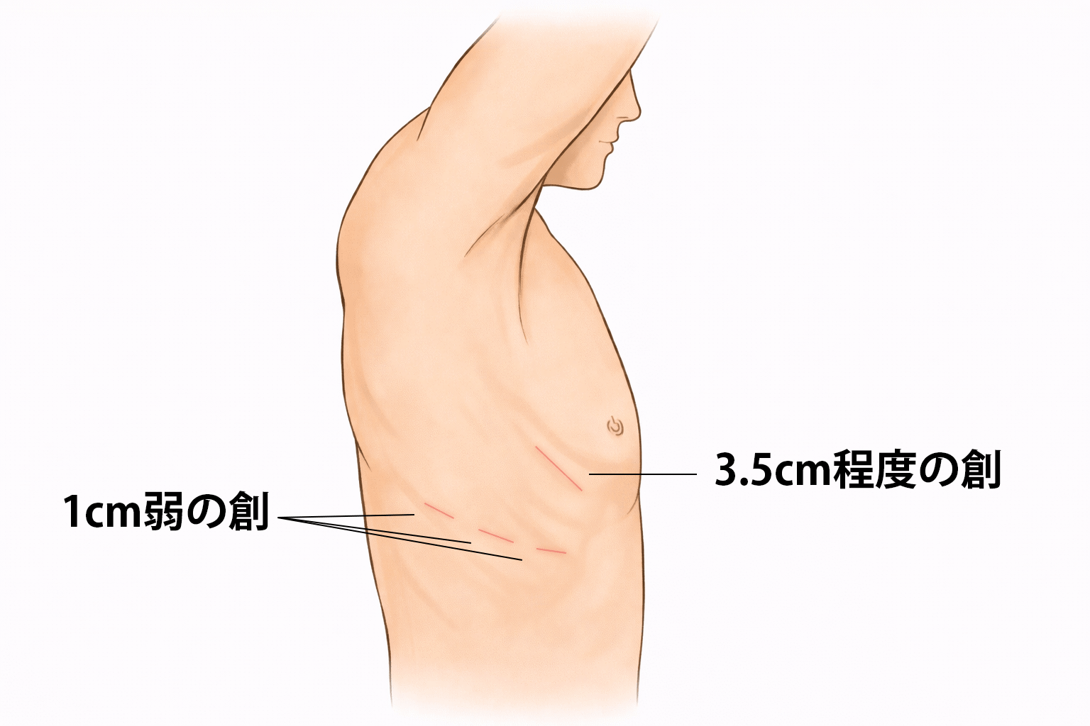 ロボット支援下手術(当科)イラスト
3個所に1cm弱の創、1箇所に3.5cm程度の創