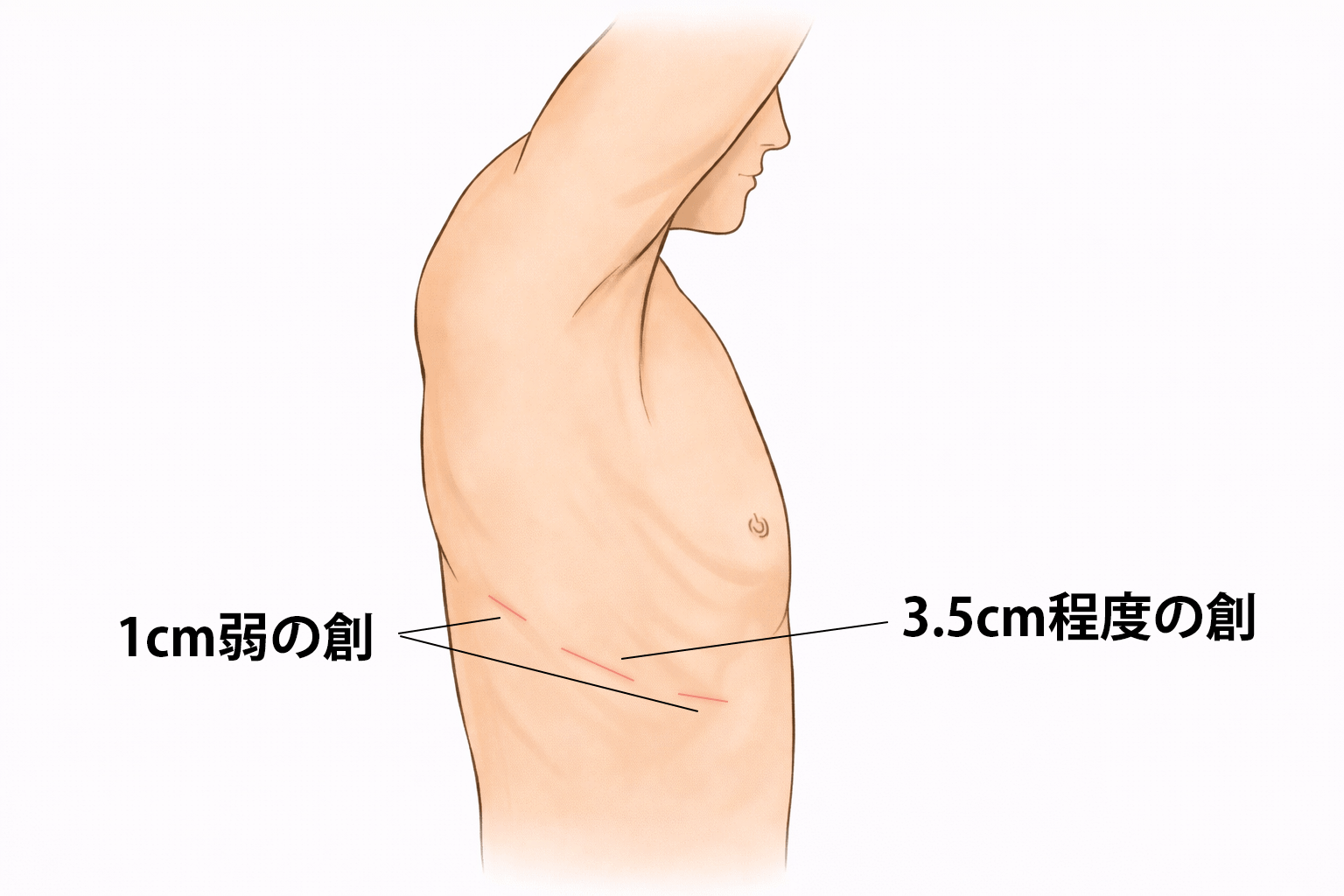 ロボット支援下手術(当科)イラスト2
2個所に1cm弱の創、1箇所に3.5cm程度の創